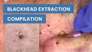 Extraction Satisfaction Blackhead Removal  CONTOUR DERMATOLOGY [upl. by Shirleen]