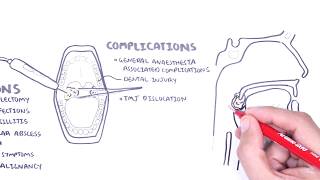 Acute Tonsillitis  causes viral bacterial pathophysiology treatment tonsillectomy [upl. by Bostow]