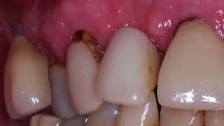 Cariology Part 7 Types of Caries [upl. by Indihar459]