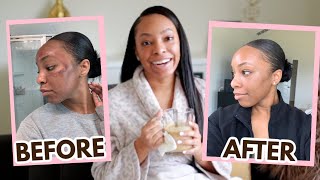 Microneedling Update  What REALLY Happened to My Skin amp How I Transformed it in 3 Weeks [upl. by Beauvais]