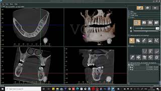 CBCT SOFTWARE DEMONSTRATION [upl. by Acinor]