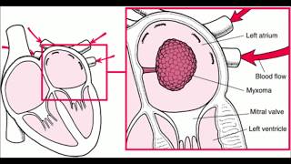 Left atrial myxoma [upl. by Issi]