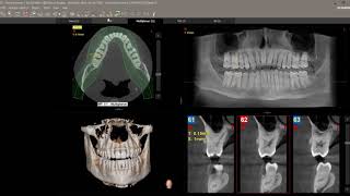 An Inside Look at the MyRay Hyperion X5 CBCT [upl. by Prescott]