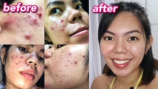 HOW I CLEARED MY ACNE  Cystic Hormonal Acne with PCOS Philippines [upl. by Aihsekram]