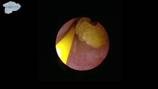 Localization of the ureter stone [upl. by Yrrehc46]