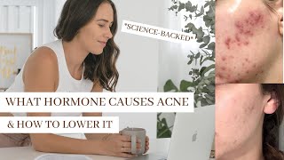 What Hormone Causes Acne PUT AN END TO HORMONAL ACNE [upl. by Anelet]