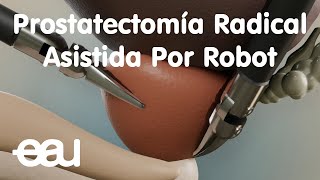 Prostatectomía Radical Asistida Por Robot [upl. by Hentrich352]