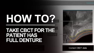 Take CBCT for a full Denture DIOnavi Learning Contents [upl. by Baptista233]