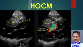 HOCM  Hypertrophic Obstructive Cardiomyopathy [upl. by Nimajnab]