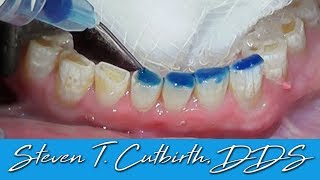 Bonding Worn Anterior Teeth  Dental Minute with Dr Steven T Cutbirth DDS [upl. by Vonny]