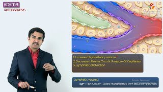 2Edema Pathogenesis  Hemodynamic pathology Fmge amp Neet PG [upl. by O'Kelly]