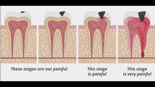 Stages of Tooth Decay Introduction [upl. by Mancino]