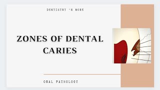 DENTAL CARIES ZONES [upl. by Tera]