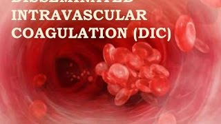 Disseminated Intravascular Coagulation [upl. by Onailime]