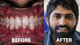 How to close Gap between teeth  Composite Bonding  FMS Dental Hospital  Hyderabad India [upl. by Greyso241]