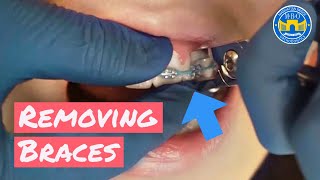 Process of Removing Braces [upl. by Ydnil]