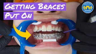 Process of Getting Braces [upl. by Anovahs]