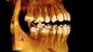 CBCT scans explained in 115 [upl. by Asselem]