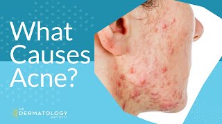 What Causes Acne  Explained by Dermatologist [upl. by Nhguav481]