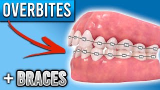 How Do BRACES FIX Overbites  Overbite Before and After Braces  Premier Orthodontics [upl. by Ahsita153]