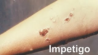 Impetigo [upl. by Avad98]