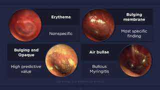 Acute Otitis Media Otoscopic Findings [upl. by Ydnir751]