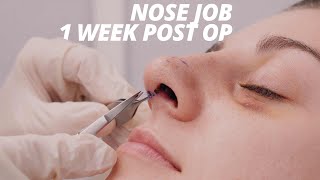 Rhinoplasty Vlog Part 2  Splint Removal and Nose Job Recovery 1 WEEK POST OP [upl. by Pippo]