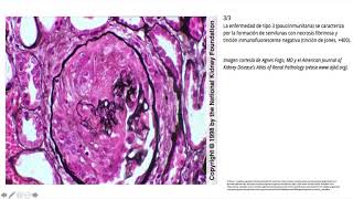 Glomerulopatias [upl. by Eicarg]