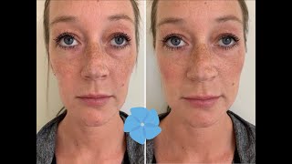 Juvederm Voluma Cheek Filler Treatment  Before  After  Nashville PA [upl. by Eniamaj]