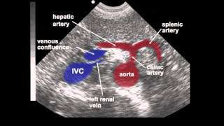 Abdominal Aortic Aneurysm AAA Ultrasound [upl. by Dlared]